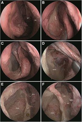 An endoscopic transnasal prelacrimal recess transmaxillary approach to the pterygopalatine fossa and infratemporal fossa